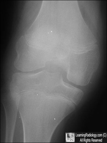 Hemophilac arthropathy